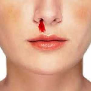 Kako zaustaviti krv iz nosa. Zašto krv iz nosa ide ujutro. Često je krv iz nosa