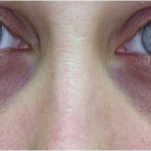 Kako očistiti modrice ispod očiju? Proučavamo učinkovite metode