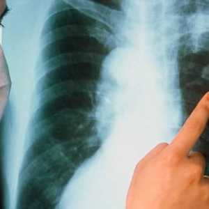 Koji je najvažniji simptom plućne tuberkuloze?