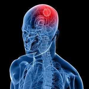 Koji je prvi znak simptoma raka mozga?