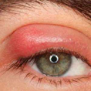 Kapi iz ječma na oku: odabir odgovarajućeg lijeka, upute