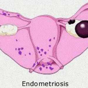 Cista pravih endometrioida jajnika: simptomi i liječenje