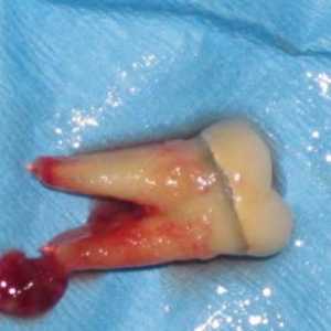 Zubna cista - što je to? Cista na korijenu zuba: uklanjanje