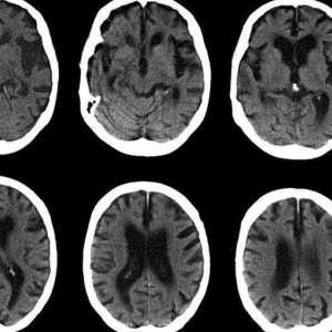 Računalni tomogram glave: pregled postupka