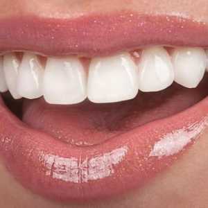 Krunice plastike za prednje zube: indikacije, recenzije, fotografije