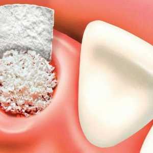 Plastična operacija kostiju za implantaciju zuba: recenzije