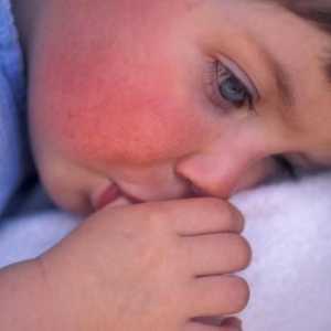 Crvena točka na obrazu djeteta: uzroci, manifestacije i karakteristike liječenja