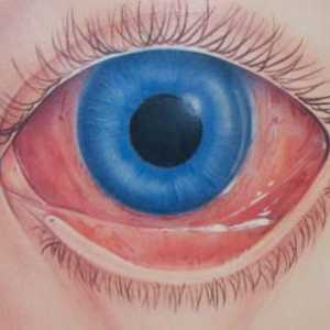 Bjelančevine crvenih očiju: uzroci, učinci i metode liječenja. Zašto crvena vjeverica gleda u…