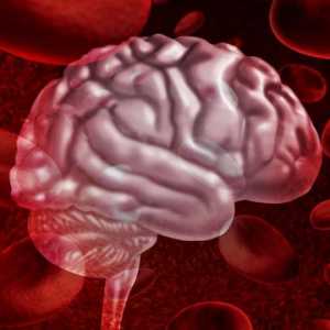 Hemorrhaga u mozgu: simptomi, liječenje, posljedice, prognozu