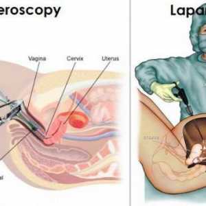 Laparoskopija i histeroskopija: indikacije, recenzije, što je bolje