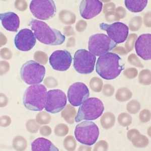 Leukemija: što je to i postoji li šansa za spasenje?