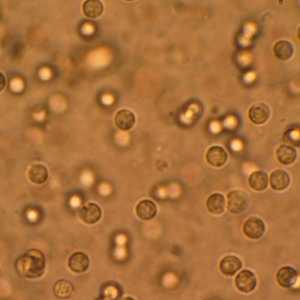 Leukociti u urinu su povišeni: uzroci i posljedice