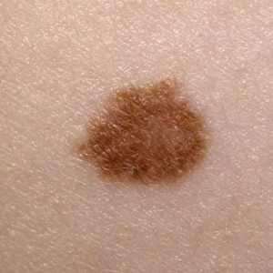 Melanom: Što je to? Simptomi bolesti, prevencija i liječenje melanoma