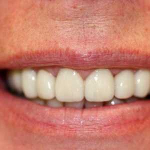 Metalni keramički zubi. Protetski stomatologija: kermeti