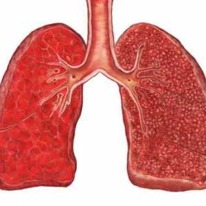 Miliarna tuberkuloza pluća: oblici, dijagnoza, simptomi, liječenje