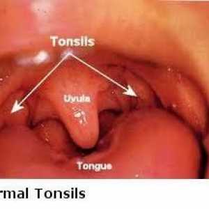 Tonzila i tonzila - kakva je razlika? Adenoidi, tonzili, tonzili
