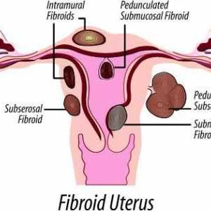 Myoma maternice: dimenzije operacije. Uterinski fibroidi: suvremene metode liječenja