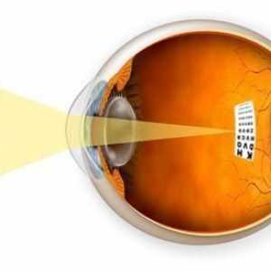 Mikaopija oka: simptomi, uzroci, dijagnoza i liječenje