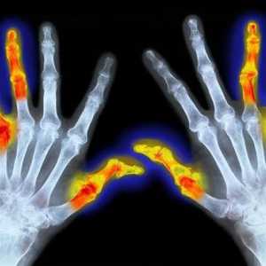 ICD 10. Reumatoidni artritis: simptomi i liječenje