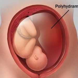 Polyhydramnios tijekom trudnoće: uzroci i posljedice. Učinak polihidramina na rad