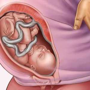 Polyhydramnios tijekom trudnoće: uzroci, liječenje, moguće posljedice za dijete