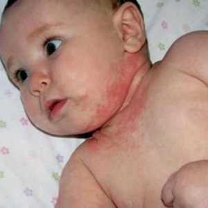 Mokro dermatitis kod djece: foto i liječenje