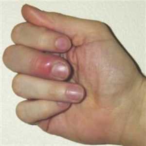 Dumps prst na ruku: uzroci, simptomi i metoda liječenja