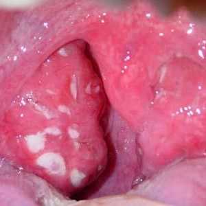 Koliko je opasna prisutnost slučajne zagušenja u grlu?