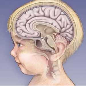 Koliko su ozbiljni učinci meningitisa kod djece?