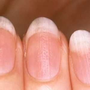 Neravne nokte na rukama: razlog, liječenje