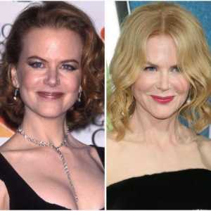 Nicole Kidman: prije i poslije plastike (fotografija)