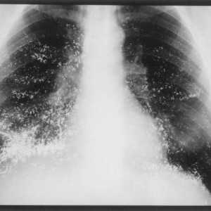 Nosokomična upala pluća: patogeni, liječenje i prevencija