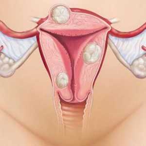 Vrlo teška bol s menstruacijom: uzroci, liječenje