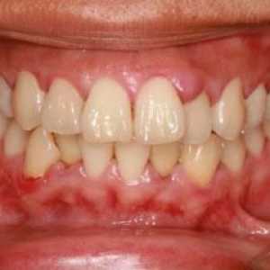 Guma se popela, ali zub ne boli - što učiniti ili zaraditi? Uzroci oticanja desni i liječenja