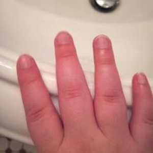 Puffy prsti na rukama: uzroci, dijagnoza, liječenje. Što učiniti ako su zglobovi na prstima natečeni