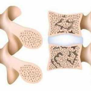 Osteoporoza kralježnice: simptomi i liječenje narodnim lijekovima