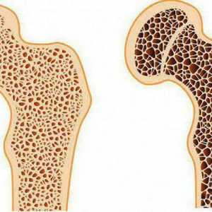 Osteoporoza zgloba kuka: simptomi i liječenje, dijagnoza