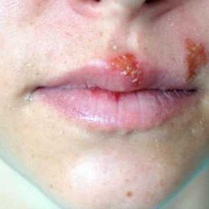 Što uzrokuje malariju na usnama? Kako liječiti ovaj podmukli virus?
