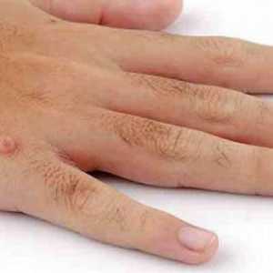 Što uzrokuje bradavice na rukama? Zašto se bradavice pojavljuju na prstima djece?