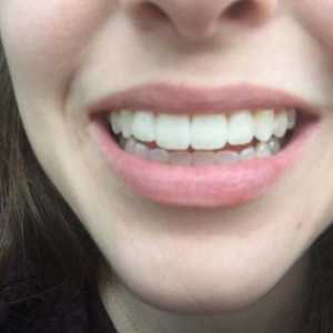Izbjeljivanje zubi Magic White: recenzije stomatologa