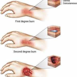 Opekline: područje opekline, određivanje po pravilu dlana. Razvrstavanje opeklina po površini i…