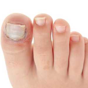Prst na nozi narwhal: uzroci i liječenje