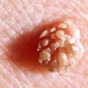 Papilloma na anusu: uzroci i metode liječenja. Folk lijekovi za papilome