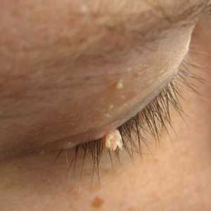 Papilloma na oku. Uzroci papiloma na kapku i metode uklanjanja