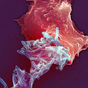 Patogeneza tuberkuloze. Etiologija tuberkuloze. Simptomi i rani znakovi tuberkuloze