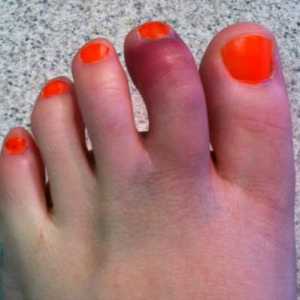 Fraktura nožni prst: simptomi i liječenje