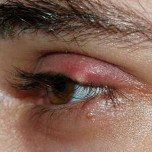 Pisyak na oku: simptomi, liječenje, prevencija
