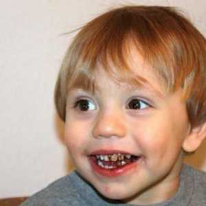 Zašto su dječji crni zubi: mogući uzroci, kako riješiti problem