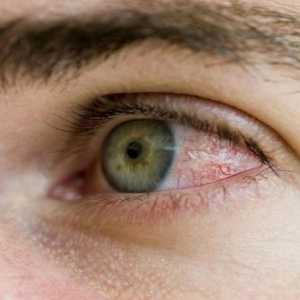 Zašto su crvene oči i kako ukloniti nelagodu?