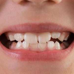 Mobilnost zuba: stupanj, uzroci, liječenje